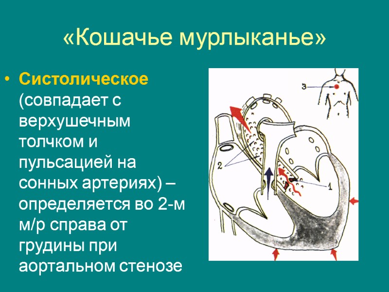 «Кошачье мурлыканье» Систолическое (совпадает с верхушечным толчком и пульсацией на сонных артериях) – определяется